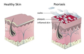Psoriasis