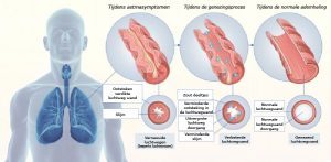 Ziekenhuis voorschrijft zware medicijnen bij astma longziekte