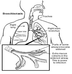 HaloClinic_Halotherapie_Bronchiectasieen_1 Halotherapie werkt bij Bronchiëctasieën
