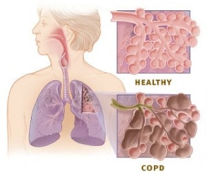 Rokers longen, COPD en halotherapie