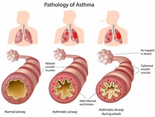 aandoening_astma_ COPD_benauwdheid Halotherapie helpt tegen uw benauwdheid