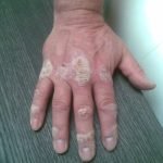 De helende werking van zout bij Psoriasis