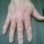 Na 5 halotherapie behandelingen in 1,5 week wist ik niet wat mij overkwam