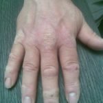 Psoriasis aan mijn handen